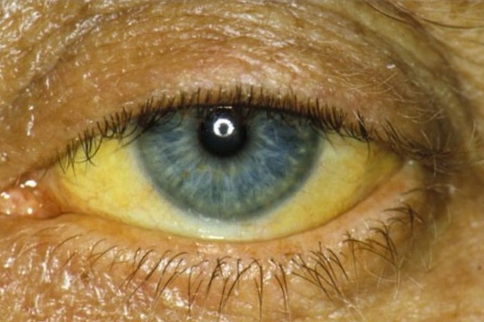 Ilustračný obrázok k článku V našom okrese opäť vyčíňa vírusová žltačka. Nový prípad z obce pri Brezne