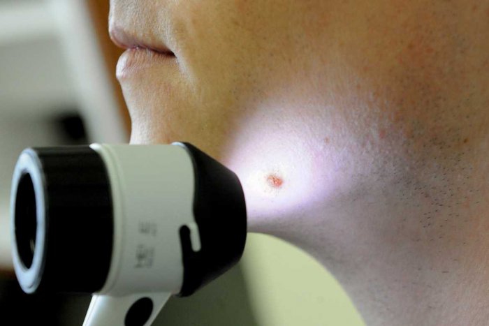 Ilustračný obrázok k článku Európsky deň melanómu v Košiciach s veľkým úspechom: Bezplatné vyšetrenie využili stovky ľudí