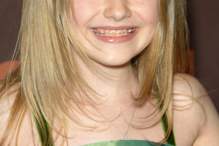 Ilustračný obrázok k článku Nosíte zubný strojček? Nestačí mať zuby biele a rovné, musia byť aj zdravé