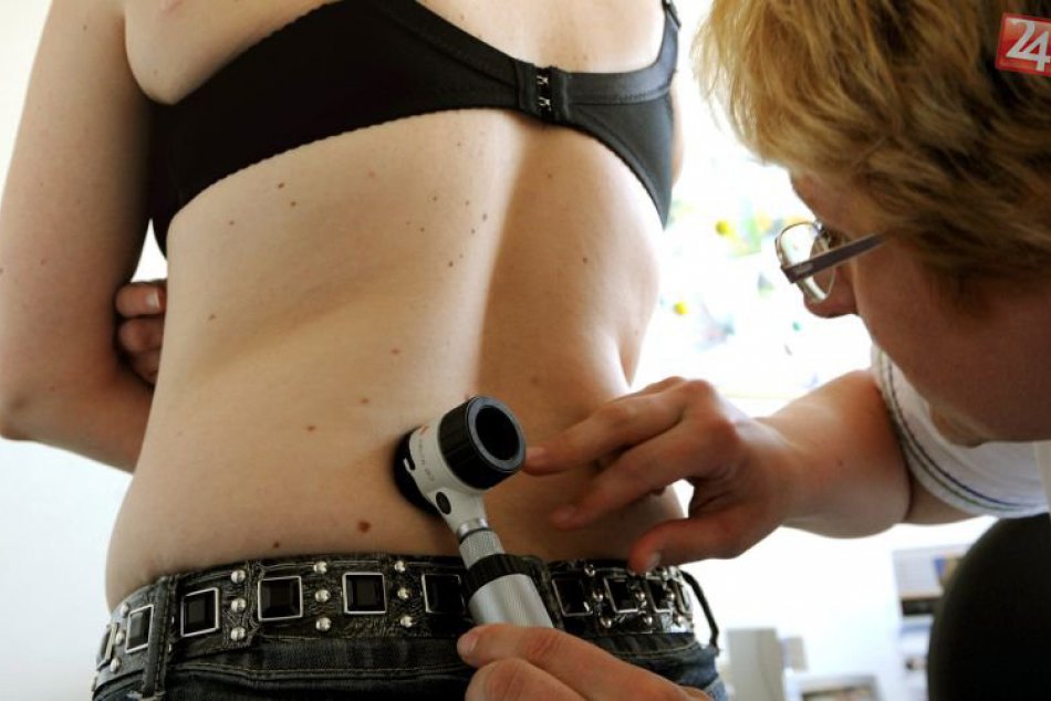 Ilustračný obrázok k článku Odborníci radia: Zmenám znamienok treba venovať pozornosť