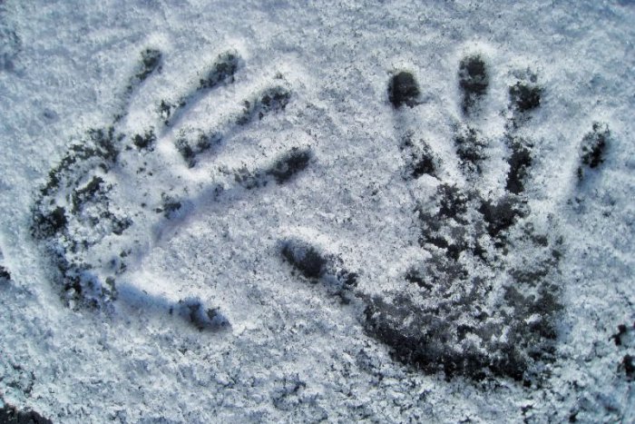 Ilustračný obrázok k článku RADÍME: Omrzliny treba zahrievať postupne, snehom sa netrú