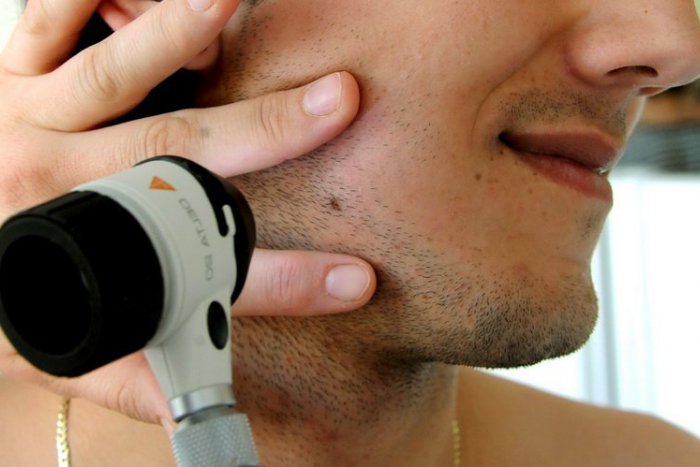 Ilustračný obrázok k článku RADÍME: Ľudí s rakovinou kože pribúda, TAKTO odhalíte podozrivé znamienka