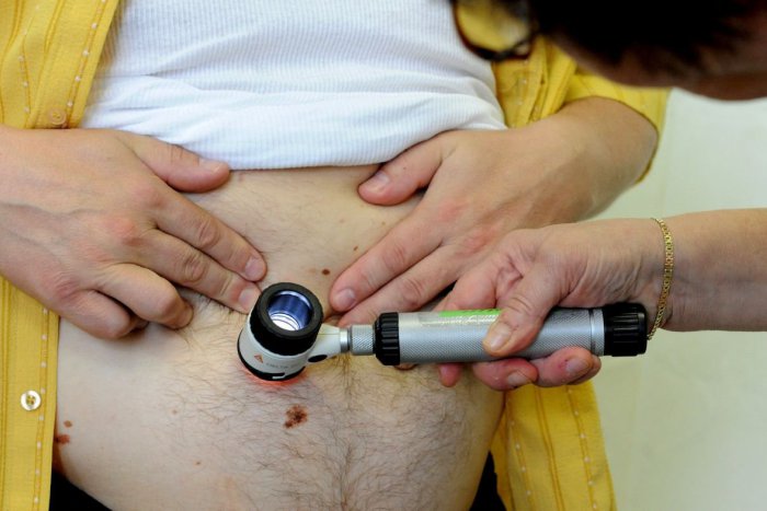 Ilustračný obrázok k článku Nepodceňujte zmeny znamienok: Včasné odhalenie problému môže zachrániť život