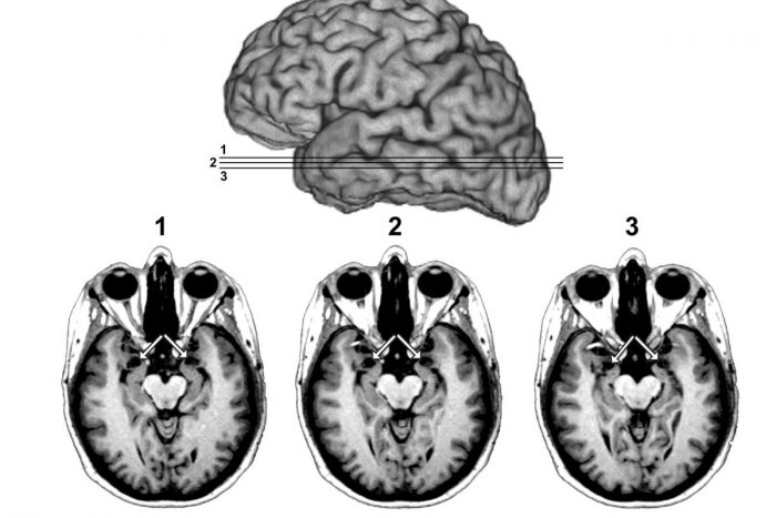 Ilustračný obrázok k článku Strašiak menom mozgová príhoda ohrozuje aj mladých Slovákov: TOTO sú príznaky