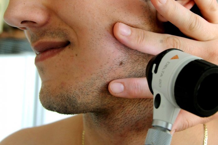 Ilustračný obrázok k článku Dobré správy: Modernú liečbu rakoviny kože od nového roka uhradí poisťovňa