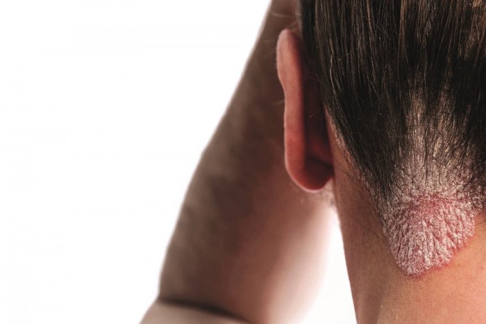 Ilustračný obrázok k článku Nepodceňujte príznaky psoriázy, teraz máte jedinečnú možnosť dať sa vyšetriť