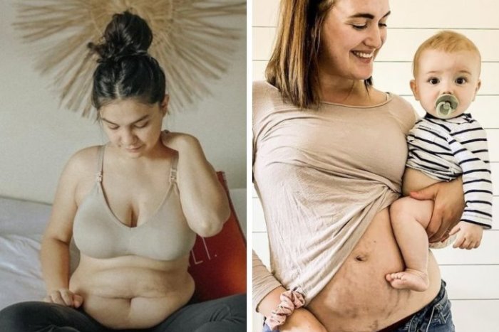 Ilustračný obrázok k článku Matky hrdo ukazujú strie a jazvy: Za svoje telo sa nehanbíme, sú znakom lásky