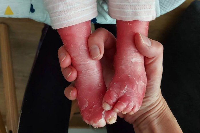 Ilustračný obrázok k článku SVET O SLOVENSKU: Dievčatko žije so zriedkavou chorobou. Lekári jej NEDÁVALI šancu!