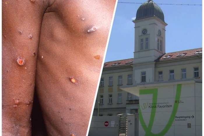 Ilustračný obrázok k článku Prvý prípad opičích kiahní pár kilometrov od Slovenska: Muž má VYRÁŽKY a príznaky chrípky!