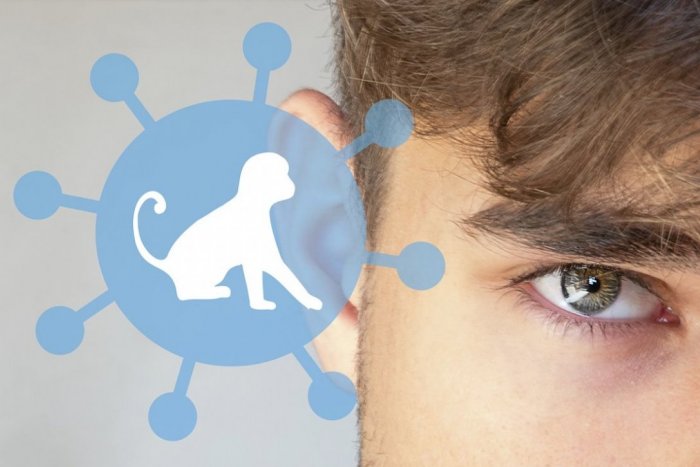 Ilustračný obrázok k článku Čech s opičími kiahňami opísal PRIEBEH ochorenia: Má pľuzgiere ako na fotkách?