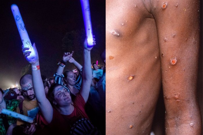 Ilustračný obrázok k článku WHO bije na poplach: Opičie kiahne sa môžu šíriť na letných FESTIVALOCH