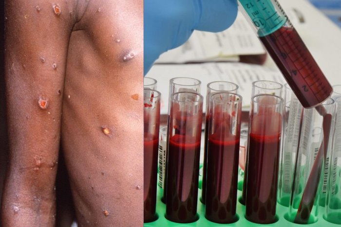 Ilustračný obrázok k článku Opičie kiahne sú už aj na Slovensku: Hygienici potvrdili PRVÝ prípad!