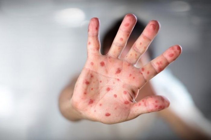 Ilustračný obrázok k článku Ďalšie prípady opičích kiahní na Slovensku: ODBORNÍCI varujú, nakazených bude pribúdať!