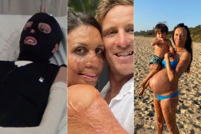 Ilustračný obrázok k článku Počas maratónu HORELA: Spálená bežkyňa prišla o svoju identitu, no našla osudovú lásku