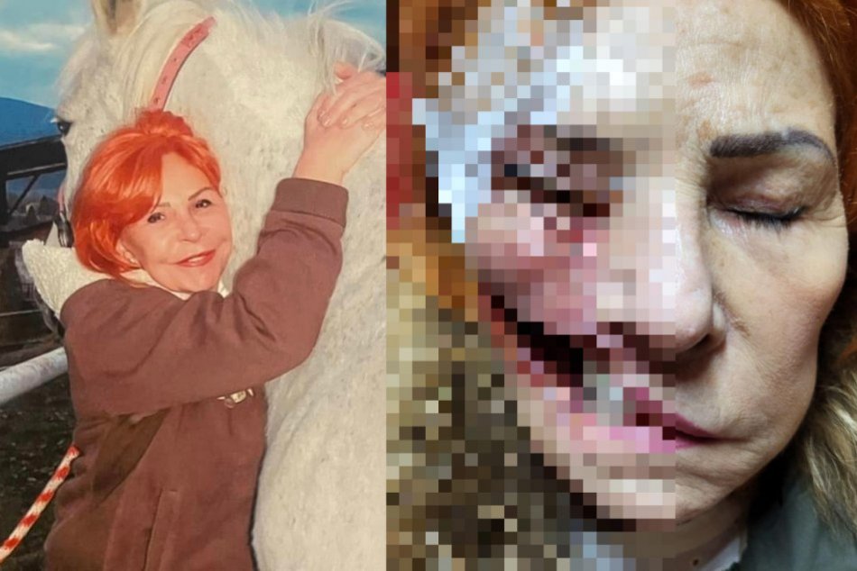 Ilustračný obrázok k článku Slovenka trpí HOROROVÝM ochorením: Parazit jej požiera tvár ZAŽIVA!
