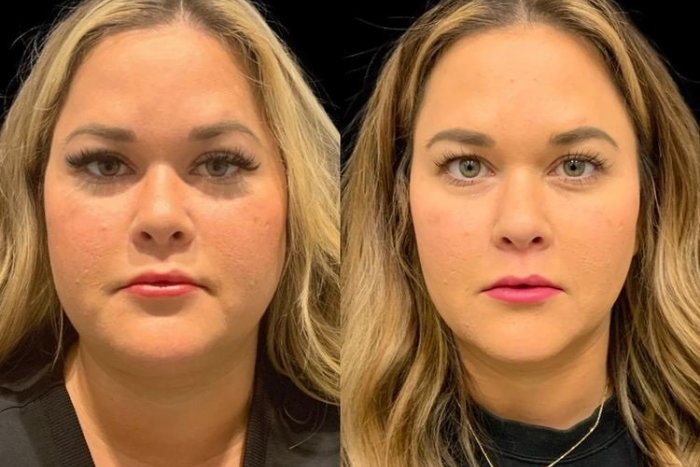 Ilustračný obrázok k článku Trápia vás BACUĽATÉ líčka? Táto procedúra je HITOM, rýchlo odstráni ich plnosť!