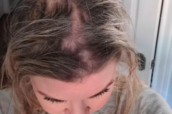 Ilustračný obrázok k článku Namiesto krásnych vlasov PLEŠINA: Ženy varujú pred šampónom, ktorý kúpite aj u nás!