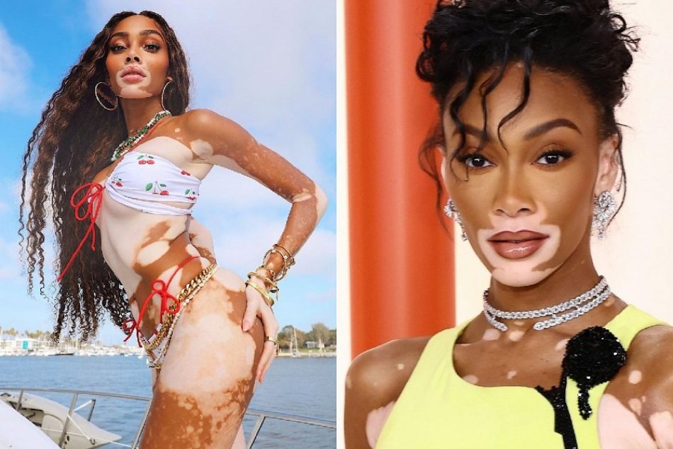 Ilustračný obrázok k článku V škole ju prezývali pre vzhľad KRAVOU: Šikanované dievča sa nevzdalo a je úspešnou modelkou!