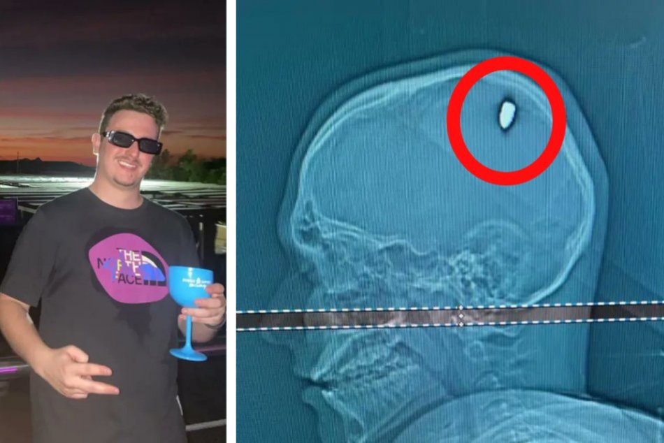 Ilustračný obrázok k článku Študent si myslel, že ho trafil kameň: Štyri dni mal v lebke zaseknutý PROJEKTIL z pištole