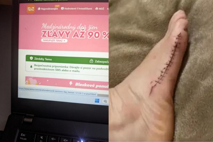 Ilustračný obrázok k článku Krv sa z nej doslova liala: Žene rozrezali nohu lacné topánky z TEMU!