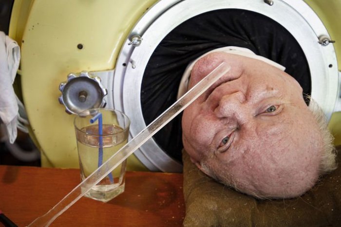 Ilustračný obrázok k článku Zomrel muž "uväznený v železných pľúcach", strávil v nich vyše 70 rokov