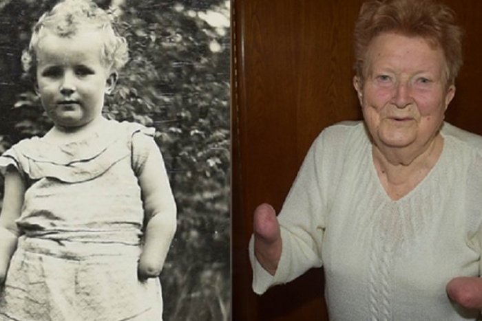 Ilustračný obrázok k článku Zomrela statočná Anička, ktorej matka ODREZALA obe rúčky. Zmrzačila aj sestričku