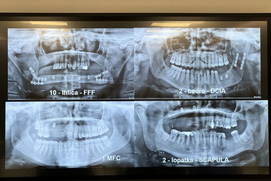 Ilustračný obrázok k článku Bystrická nemocnica je medzi prvými na Slovensku: Pacientom už nahradí čelusť aj zuby, FOTO