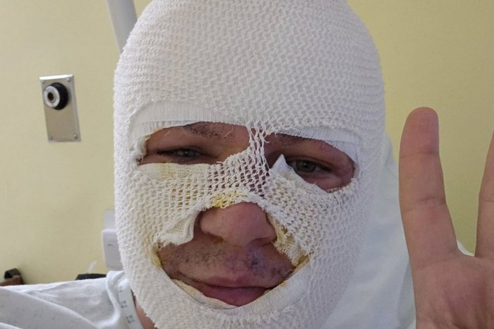 Ilustračný obrázok k článku Známy exposlanec zverejnil ŠOKUJÚCI záber: Skončil s POPÁLENINAMI 1. a 2. stupňa