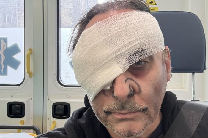 Ilustračný obrázok k článku HOROROVÉ zranenie na javisku! Slovenský spevák si takmer VYPICHOL oko!