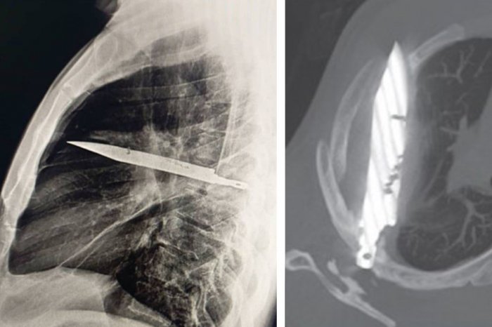 Ilustračný obrázok k článku Lekár zažil ŠOK! Röntgen odhalil, že muž mal 8 rokov v hrudníku zapichnutý NÔŽ