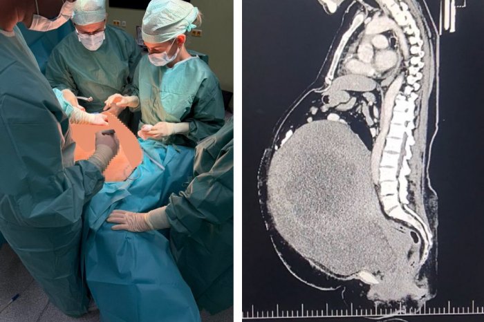 Ilustračný obrázok k článku Neuveriteľný ÚSPECH: V Komárne žene vyoperovali OBROVSKÝ nádor! Vážil 18 KÍL