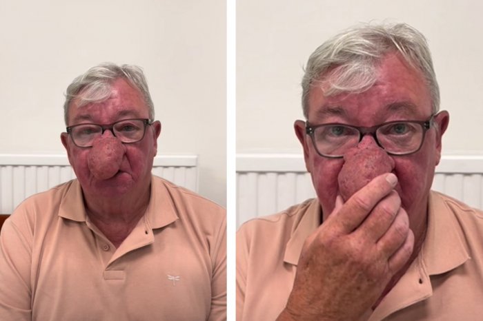 Ilustračný obrázok k článku Muža choroba zmenila na nepoznanie: OBROVSKÝ nos mu bránil piť pivo aj bozkávať ženu