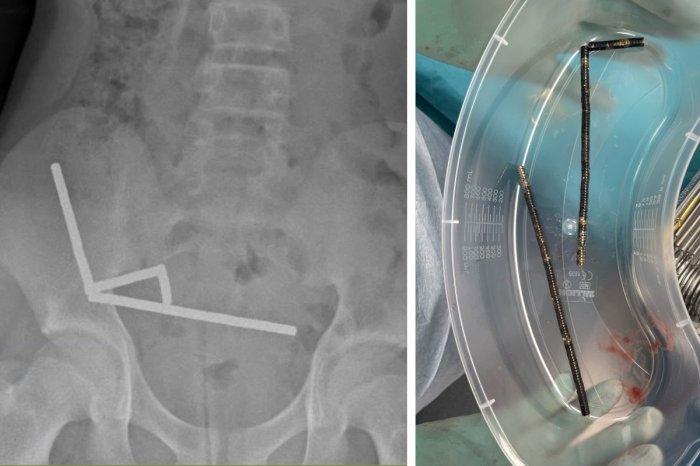 Ilustračný obrázok k článku Chlapec (13) mal neznesiteľné bolesti: Zjedol takmer STO magnetov! Prišiel o kus čreva