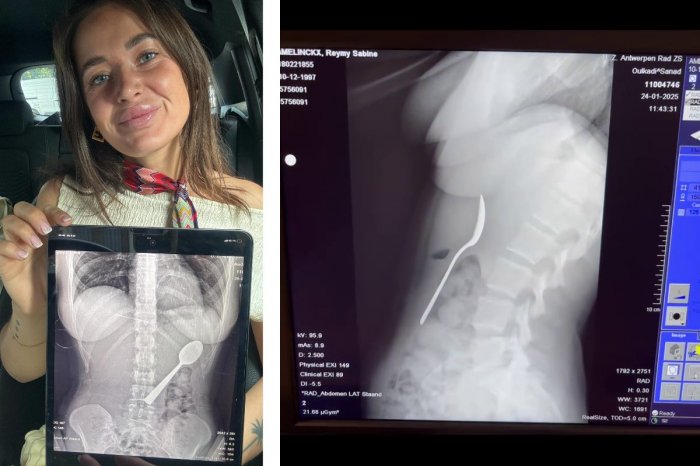 Ilustračný obrázok k článku BIZARNÁ nehoda: Na ženu vyskočil pes a... PREHLTLA 17-centimetrovú lyžicu!