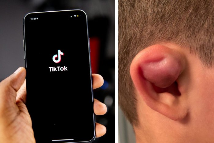 Ilustračný obrázok k článku Poznáte KARFIOLOVÉ uši? Mladí si pre trend na TikToku dobrovoľne NIČIA uši!