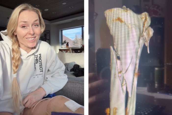 Ilustračný obrázok k článku Desivý pád Vonnovej na olympiáde mohol mať FATÁLNE následky: Hrozila jej AMPUTÁCIA