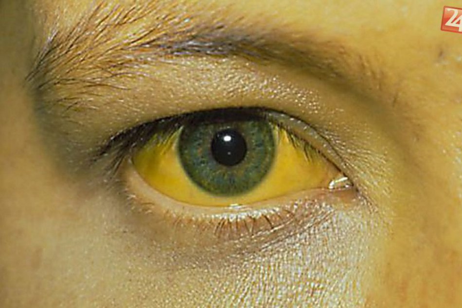 Na južnej Morave úraduje žltačka. Na Slovensko ešte epidémia nedorazila