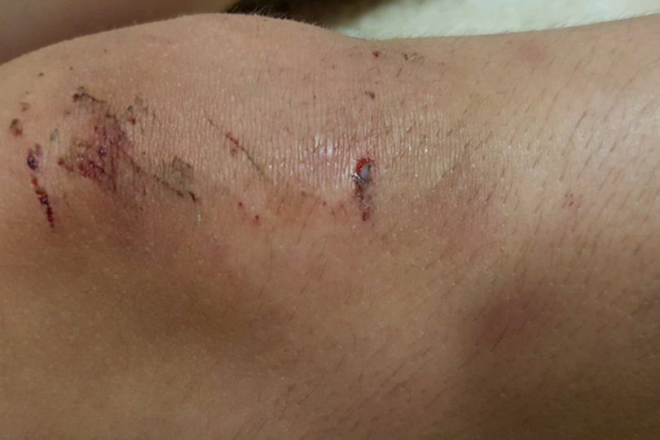 Výrub v Zoborských vrchoch: Z cyklistiky si Nitran odniesol poriadne škrabance