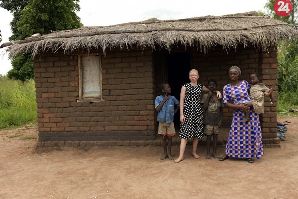 Albínka Catherine v Malawi