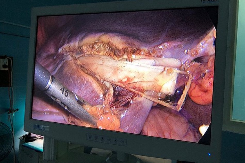 Rus žil roky s obrovským kusom skla v pečeni