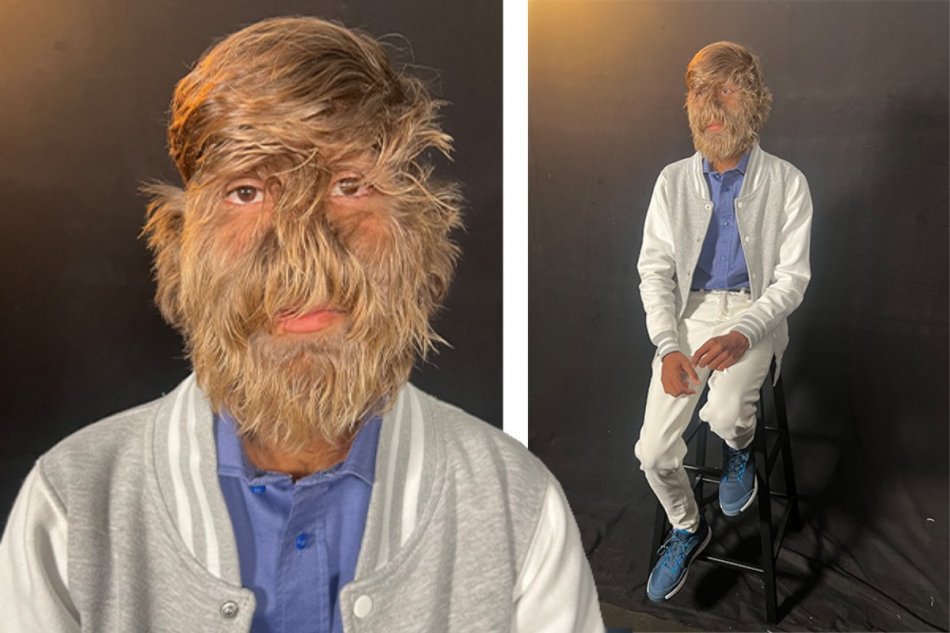 Chlapec trpí vlkolačím syndrómom - má najchlpatejšiu tvár na svete