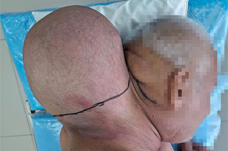 Mužovi na krku 16 rokov rástol obrovský nádor